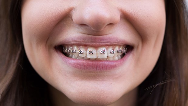 Braces Treatment in Kaneohe - Braces Treatment Price Hawaii