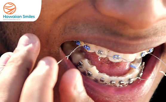 Is a Loose Bracket an Orthodontic Emergency