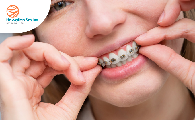 Can I Wear Braces if I Have Periodontal Disease?