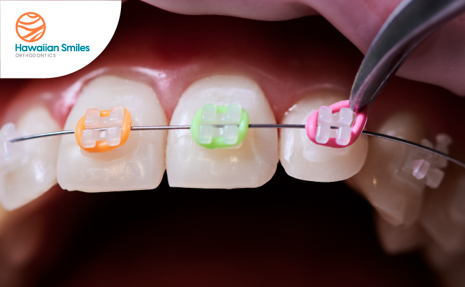 braces colors combinations