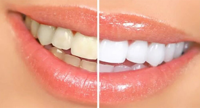 Teeth Whitening in Kaneohe, HI - Hawaiian Smiles Ortho